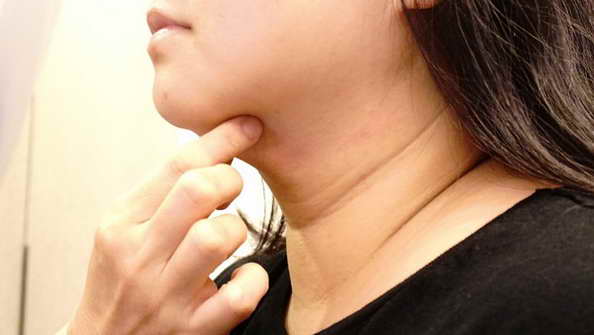 想和「雙下巴斷捨離」只靠節食、運動好難!熟女媽媽求助「冷凍減脂」找回自信 想和「雙下巴斷捨離」只靠節食、運動好難!熟女媽媽求助「冷凍減脂」找回自信