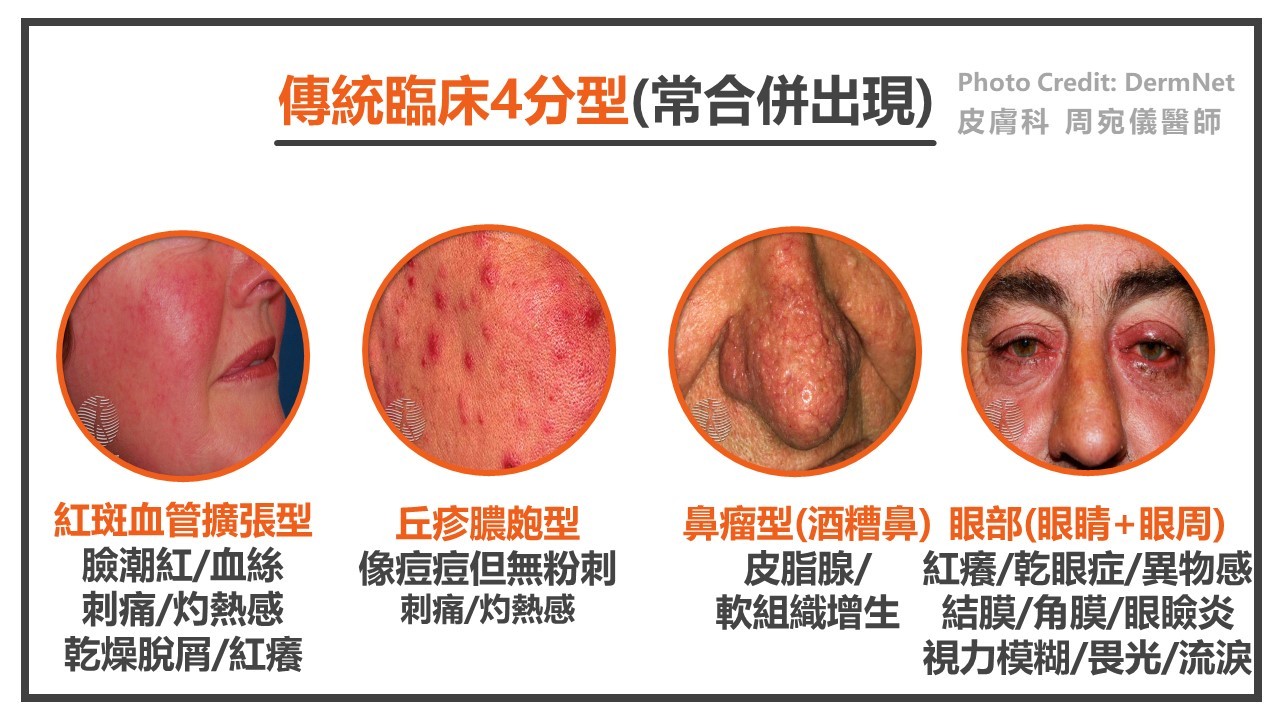 讓酒糟肌不糟 醫籲做好「4件事」:少吃辣、別碰火鍋! 讓酒糟肌不糟 醫籲做好「4件事」:少吃辣、別碰火鍋!